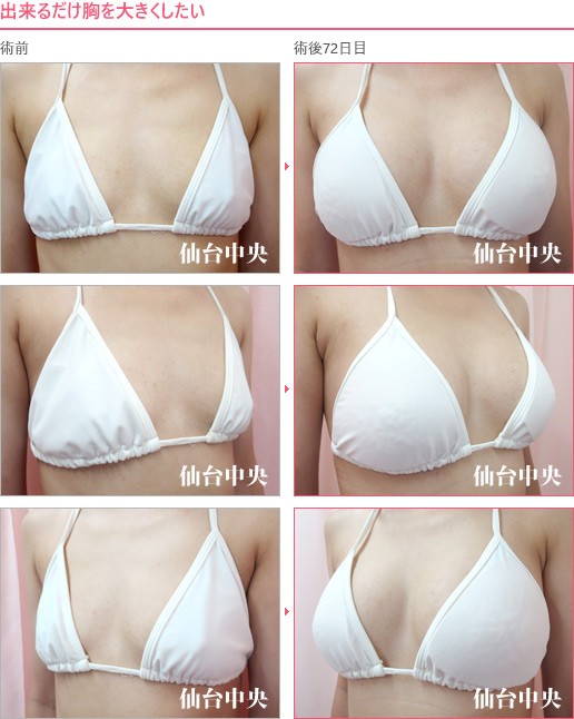 出来るだけ胸を大きくしたい 症例写真