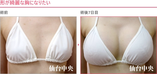 形の綺麗な胸 症例写真