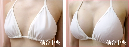 形の綺麗な胸 症例写真3