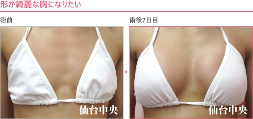 形の綺麗な胸 症例写真