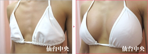 形の綺麗な胸 症例写真3