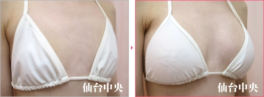 形の綺麗な胸 症例写真2