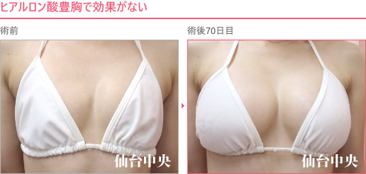他院ヒアルロン酸豊胸の修正症例写真、術前・術後70日の比較 - 30代女性、正面