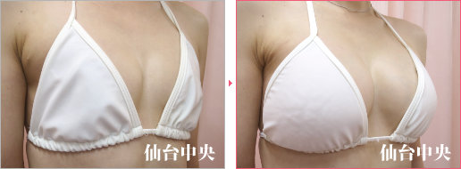 他院ヒアルロン酸豊胸の修正症例写真、術前・術後70日の比較 - 30代女性、右前