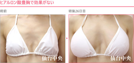 他院ヒアルロン酸豊胸の修正症例写真、術前・術後26日の比較 - 40代女性、正面