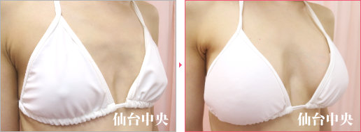 他院ヒアルロン酸豊胸の修正症例写真、術前・術後26日の比較 - 40代女性、右前