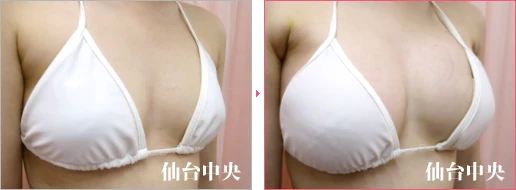 派手な水着を着たい 症例写真2
