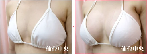 派手な水着を着たい 症例写真3