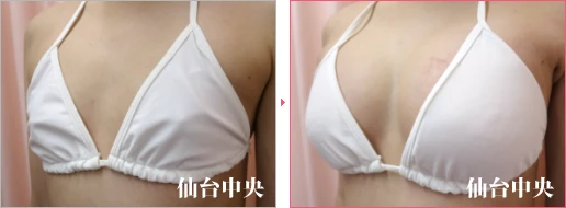 派手な水着を着たい 症例写真3