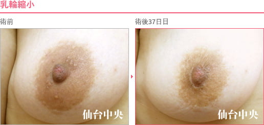 乳輪縮小 症例写真