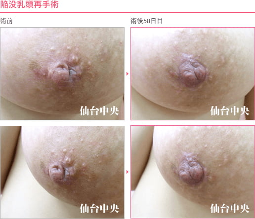 陥没乳頭再手術 症例写真