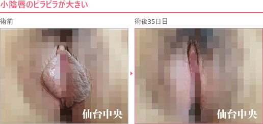 小陰唇のビラビラが大きい 症例写真