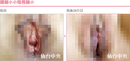 膣縮小小陰唇縮小 症例写真